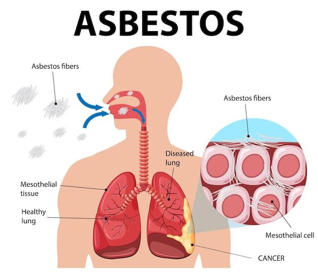 Diagram showing asbestosis in lungs